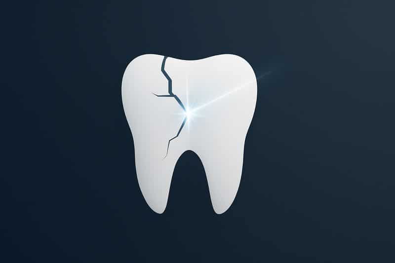 הבנת נזקי סדק בשן בעקבות חבלה דנטלית איור של שן סדוקה הממחיש סוג נזק אפשרי כתוצאה מחבלה בשיניים קדמיות או אחרות