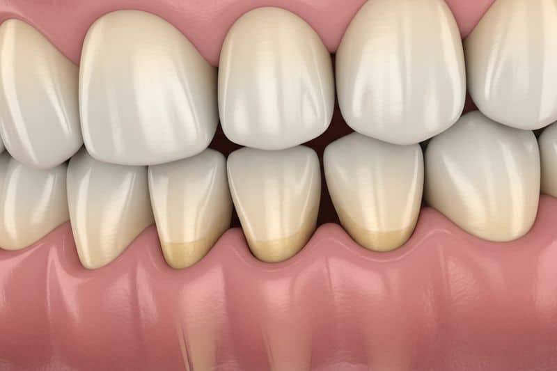 חשיפת שורשי שיניים כתוצאה מהזנחה של טיפול דלקת חניכיים