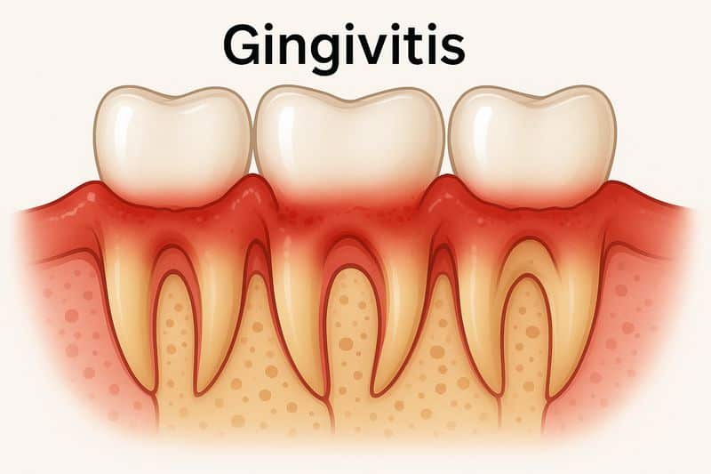 דלקת חניכיים טיפול מקצועי - השוואה בין מצב תקין לפתולוגי איור רפואי של דלקת חניכיים והשפעתה על רקמות השן - טיפול בדלקת חניכיים חריפה