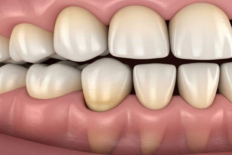 טיפול נסיגת חניכיים - המחשה של שורש שן חשוף הדמיה של נסיגת חניכיים בשיניים הקדמיות - דוגמה למקרה הדורש טיפול בנסיגת חניכיים