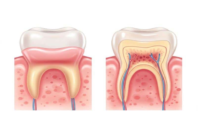 השוואה בין חניכיים בריאות לנסיגת חניכיים – מתי מתחיל טיפול? איור של נסיגת חניכיים – השוואה בין מצב תקין לבין מצב הדורש טיפול