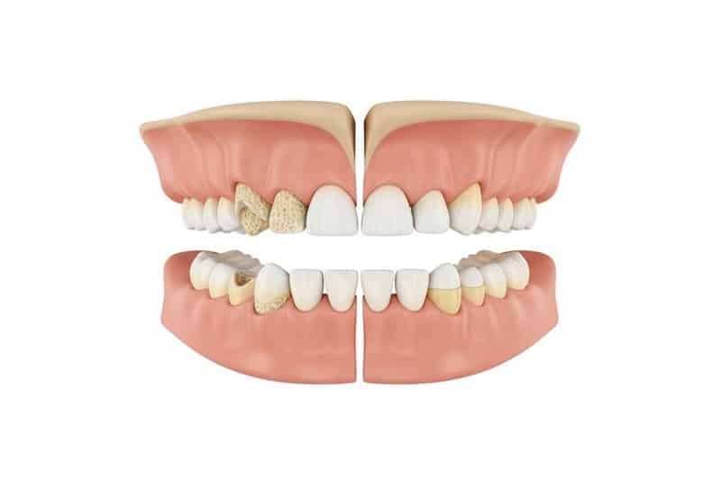 שימור עצם לאחר עקירת שן – הדמיה של הלסת הדמיה רפואית של עצם הלסת לאחר עקירת שן והשפעת שימור עצם